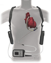 Abbott HeartMate 3™ LVAS