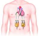 Thoratec PVAD